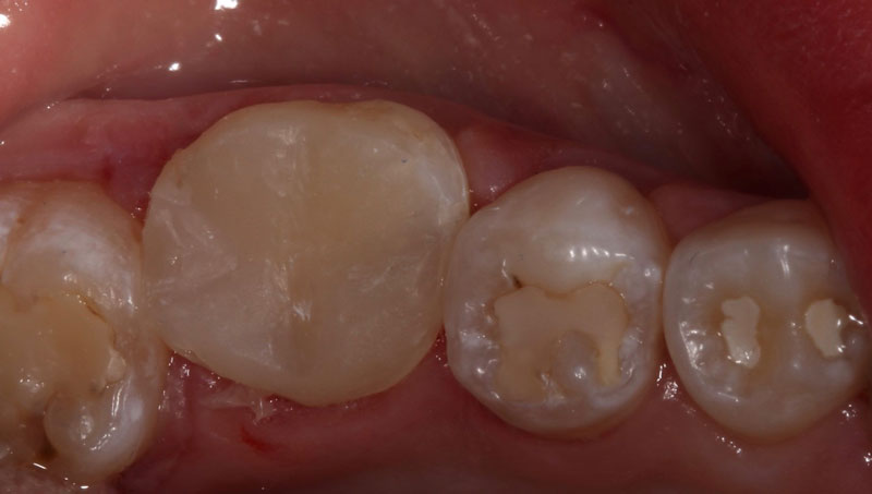 Pulp Capping: Can We and Should We? Janiga pulp capping should we 08