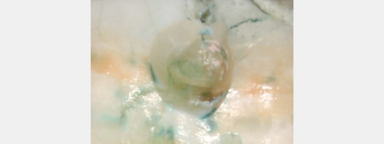 Using Caries Detection Dyes