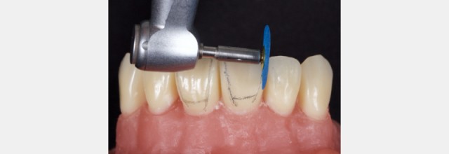 Finishing Anterior Composite: How to Recreate Natural Enamel Morphology and Texture