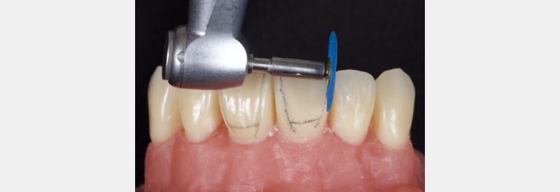 Finishing Anterior Composite: How to Recreate Natural Enamel Morphology and Texture JasonSmithson FinishingAntComp Fig.1