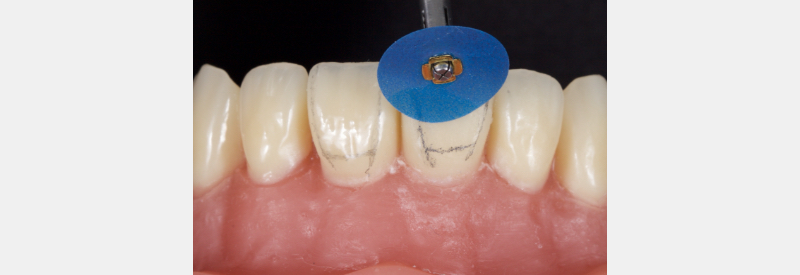 Finishing Anterior Composite: How to Recreate Natural Enamel Morphology and Texture JasonSmithson FinishingAntComp Fig.2