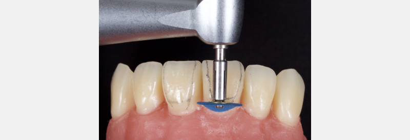 Finishing Anterior Composite: How to Recreate Natural Enamel Morphology and Texture JasonSmithson FinishingAntComp Fig.3