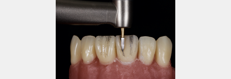 Finishing Anterior Composite: How to Recreate Natural Enamel Morphology and Texture JasonSmithson FinishingAntComp Fig.4