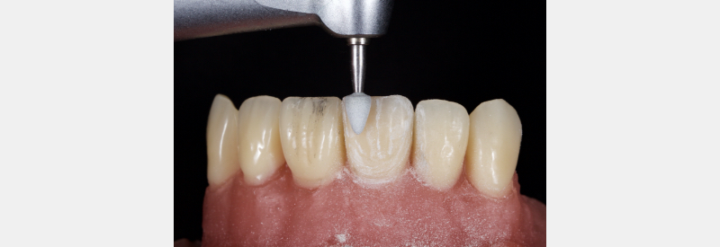Finishing Anterior Composite: How to Recreate Natural Enamel Morphology and Texture JasonSmithson FinishingAntComp Fig.5