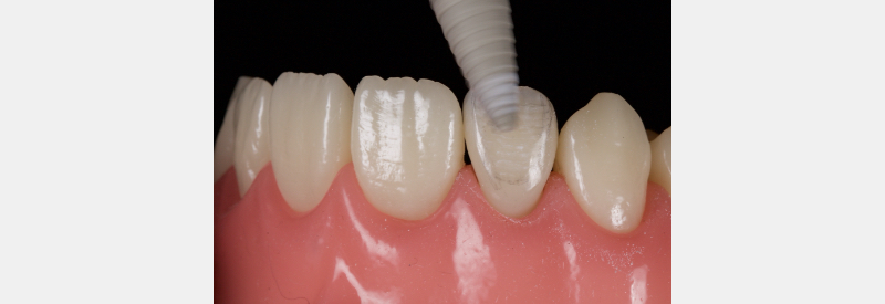Finishing Anterior Composite: How to Recreate Natural Enamel Morphology and Texture JasonSmithson FinishingAntComp Fig.6