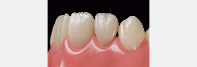 Finishing Anterior Composite: How to Recreate Natural Enamel Morphology and Texture JasonSmithson FinishingAntComp Fig.7