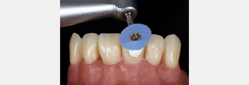 Finishing Anterior Composite: How to Recreate Natural Enamel Morphology and Texture JasonSmithson FinishingAntComp Fig.8
