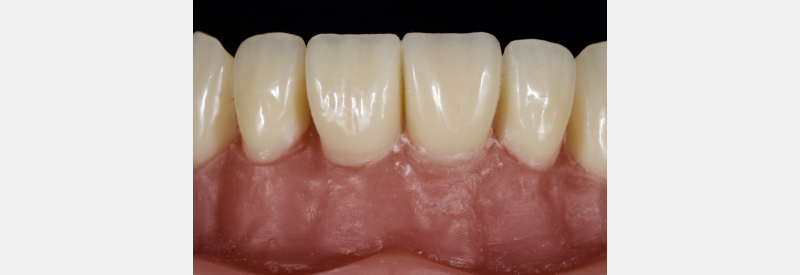 Finishing Anterior Composite: How to Recreate Natural Enamel Morphology and Texture JasonSmithson FinishingAntComp Fig.9