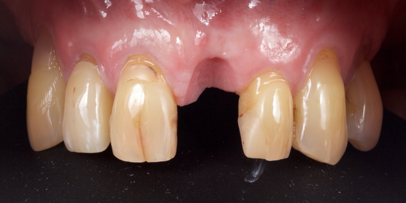 Lithium Disilicate Resin-Retained Adhesive Bridgework in Fixed Prosthodontics JasonSmithson LithiumDisilicateResinRetAdhBridge Fig.1