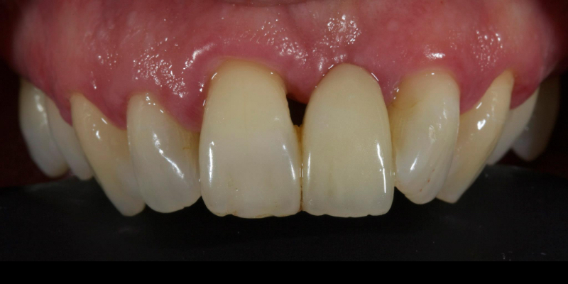Lithium Disilicate Resin-Retained Adhesive Bridgework in Fixed Prosthodontics JasonSmithson LithiumDisilicateResinRetAdhBridge Fig.10