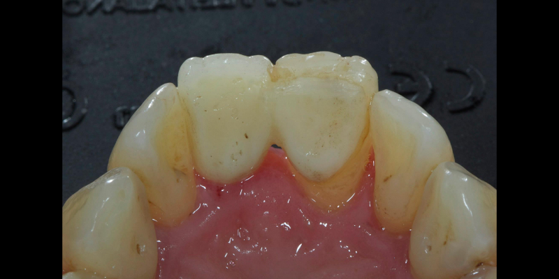 Lithium Disilicate Resin-Retained Adhesive Bridgework in Fixed Prosthodontics JasonSmithson LithiumDisilicateResinRetAdhBridge Fig.11