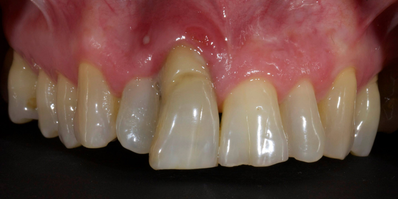 Lithium Disilicate Resin-Retained Adhesive Bridgework in Fixed Prosthodontics JasonSmithson LithiumDisilicateResinRetAdhBridge Fig.13