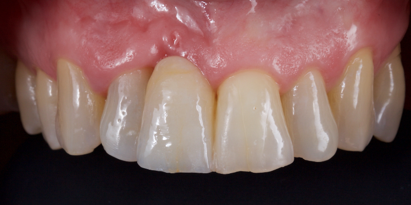 Lithium Disilicate Resin-Retained Adhesive Bridgework in Fixed Prosthodontics JasonSmithson LithiumDisilicateResinRetAdhBridge Fig.14