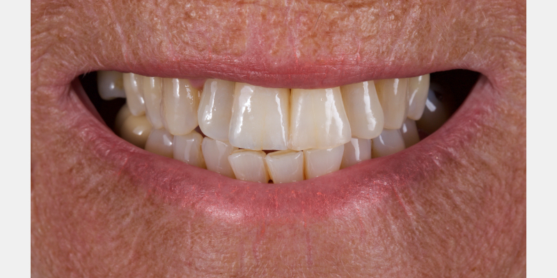 Lithium Disilicate Resin-Retained Adhesive Bridgework in Fixed Prosthodontics JasonSmithson LithiumDisilicateResinRetAdhBridge Fig.15