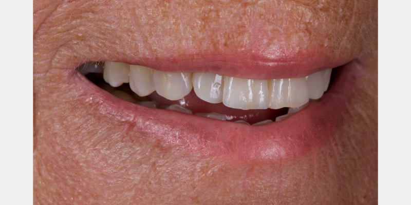 Lithium Disilicate Resin-Retained Adhesive Bridgework in Fixed Prosthodontics JasonSmithson LithiumDisilicateResinRetAdhBridge Fig.16