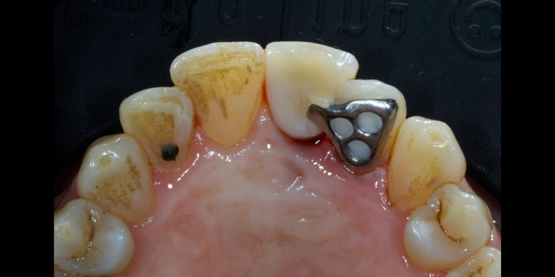 Lithium Disilicate Resin-Retained Adhesive Bridgework in Fixed Prosthodontics JasonSmithson LithiumDisilicateResinRetAdhBridge Fig.17