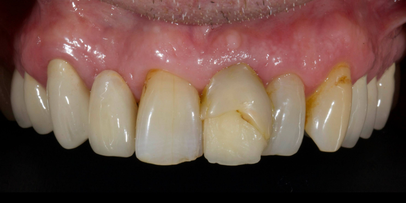 Lithium Disilicate Resin-Retained Adhesive Bridgework in Fixed Prosthodontics JasonSmithson LithiumDisilicateResinRetAdhBridge Fig.18
