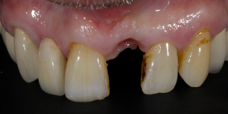 Lithium Disilicate Resin-Retained Adhesive Bridgework in Fixed Prosthodontics JasonSmithson LithiumDisilicateResinRetAdhBridge Fig.19
