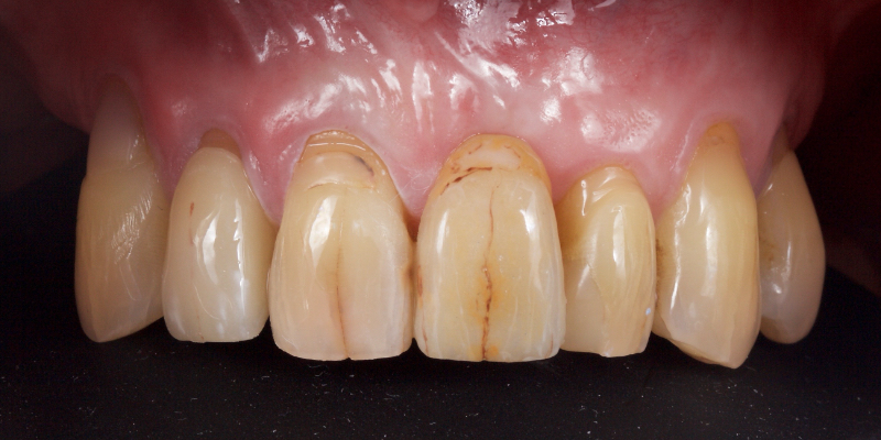 Lithium Disilicate Resin-Retained Adhesive Bridgework in Fixed Prosthodontics JasonSmithson LithiumDisilicateResinRetAdhBridge Fig.2