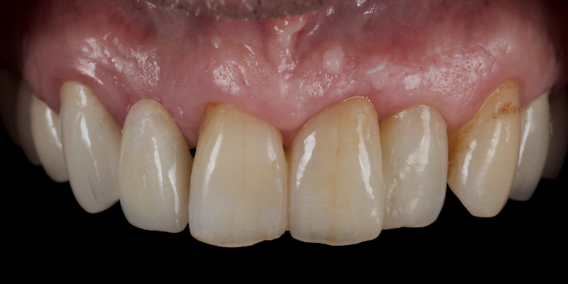 Lithium Disilicate Resin-Retained Adhesive Bridgework in Fixed Prosthodontics JasonSmithson LithiumDisilicateResinRetAdhBridge Fig.20