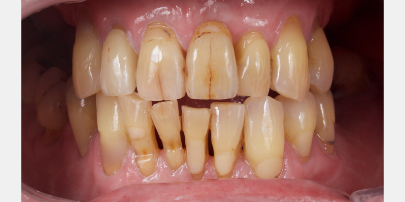 Lithium Disilicate Resin-Retained Adhesive Bridgework in Fixed Prosthodontics JasonSmithson LithiumDisilicateResinRetAdhBridge Fig.3 1