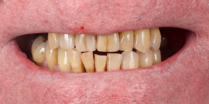 Lithium Disilicate Resin-Retained Adhesive Bridgework in Fixed Prosthodontics JasonSmithson LithiumDisilicateResinRetAdhBridge Fig.4