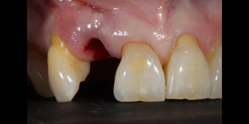 Lithium Disilicate Resin-Retained Adhesive Bridgework in Fixed Prosthodontics JasonSmithson LithiumDisilicateResinRetAdhBridge Fig.5