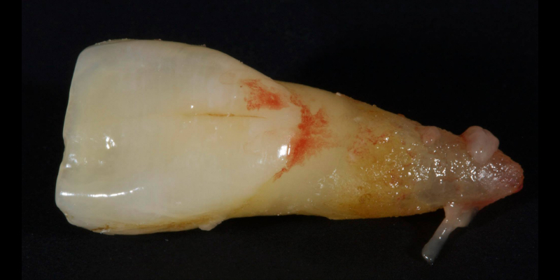 Lithium Disilicate Resin-Retained Adhesive Bridgework in Fixed Prosthodontics JasonSmithson LithiumDisilicateResinRetAdhBridge Fig.6
