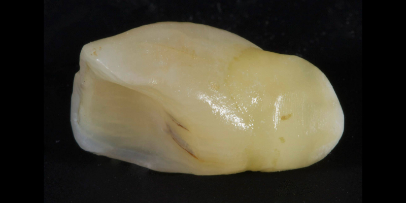 Lithium Disilicate Resin-Retained Adhesive Bridgework in Fixed Prosthodontics JasonSmithson LithiumDisilicateResinRetAdhBridge Fig.7