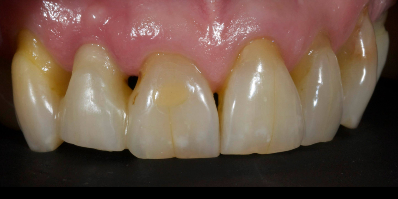 Lithium Disilicate Resin-Retained Adhesive Bridgework in Fixed Prosthodontics JasonSmithson LithiumDisilicateResinRetAdhBridge Fig.8