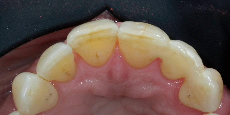Lithium Disilicate Resin-Retained Adhesive Bridgework in Fixed Prosthodontics JasonSmithson LithiumDisilicateResinRetAdhBridge Fig.9