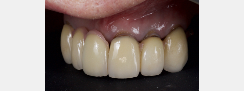 Old Tricks for New Dogs: Vertical Margin in Fixed Prosthodontics JasonSmithson OldTricksNewDogsVertMargin Fig.1