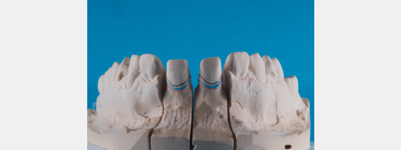 Old Tricks for New Dogs: Vertical Margin in Fixed Prosthodontics JasonSmithson OldTricksNewDogsVertMargin Fig.10