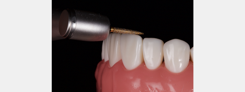 Old Tricks for New Dogs: Vertical Margin in Fixed Prosthodontics JasonSmithson OldTricksNewDogsVertMargin Fig.12