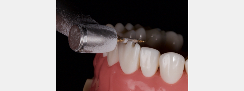 Old Tricks for New Dogs: Vertical Margin in Fixed Prosthodontics JasonSmithson OldTricksNewDogsVertMargin Fig.13