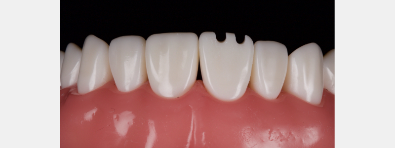 Old Tricks for New Dogs: Vertical Margin in Fixed Prosthodontics JasonSmithson OldTricksNewDogsVertMargin Fig.14