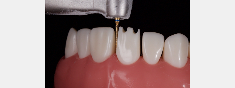 Old Tricks for New Dogs: Vertical Margin in Fixed Prosthodontics JasonSmithson OldTricksNewDogsVertMargin Fig.15