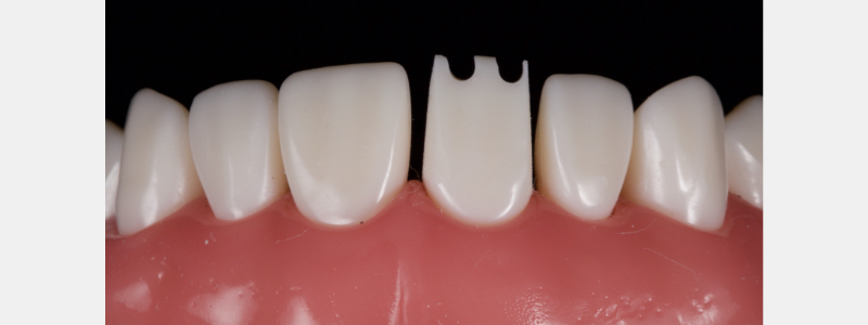 Old Tricks for New Dogs: Vertical Margin in Fixed Prosthodontics JasonSmithson OldTricksNewDogsVertMargin Fig.16
