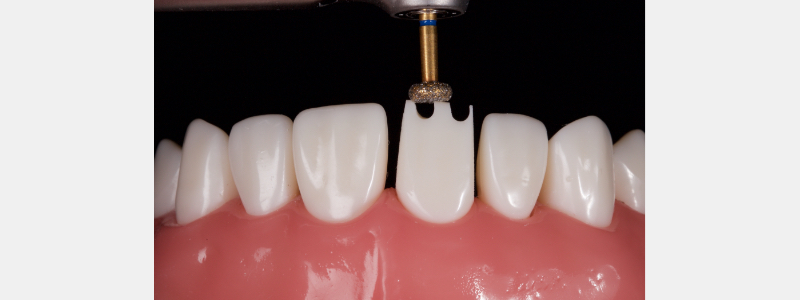Old Tricks for New Dogs: Vertical Margin in Fixed Prosthodontics JasonSmithson OldTricksNewDogsVertMargin Fig.17