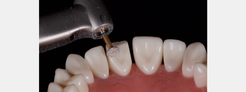 Old Tricks for New Dogs: Vertical Margin in Fixed Prosthodontics JasonSmithson OldTricksNewDogsVertMargin Fig.18