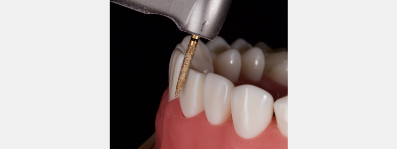 Old Tricks for New Dogs: Vertical Margin in Fixed Prosthodontics JasonSmithson OldTricksNewDogsVertMargin Fig.19
