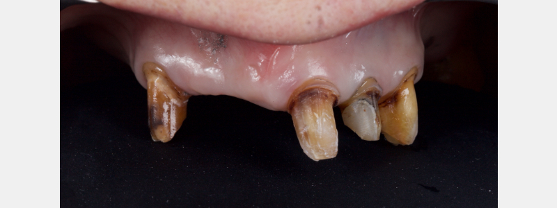 Old Tricks for New Dogs: Vertical Margin in Fixed Prosthodontics JasonSmithson OldTricksNewDogsVertMargin Fig.2