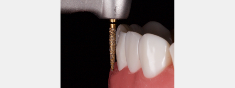 Old Tricks for New Dogs: Vertical Margin in Fixed Prosthodontics JasonSmithson OldTricksNewDogsVertMargin Fig.20