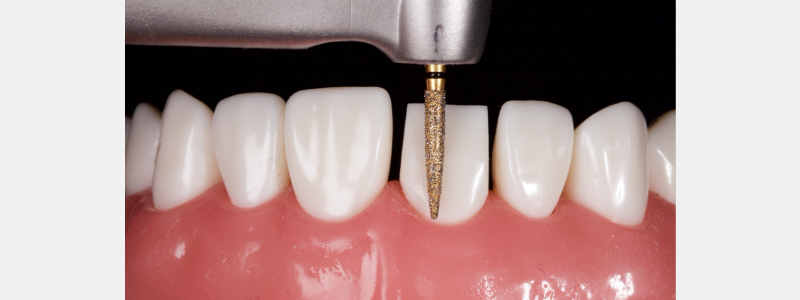 Old Tricks for New Dogs: Vertical Margin in Fixed Prosthodontics JasonSmithson OldTricksNewDogsVertMargin Fig.21