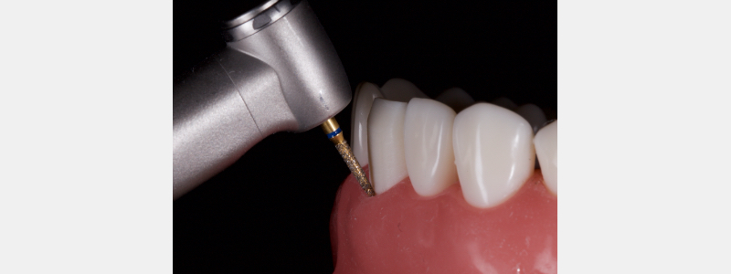 Old Tricks for New Dogs: Vertical Margin in Fixed Prosthodontics JasonSmithson OldTricksNewDogsVertMargin Fig.22