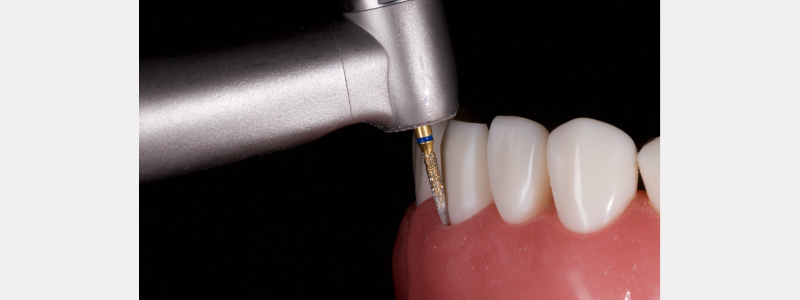 Old Tricks for New Dogs: Vertical Margin in Fixed Prosthodontics JasonSmithson OldTricksNewDogsVertMargin Fig.23