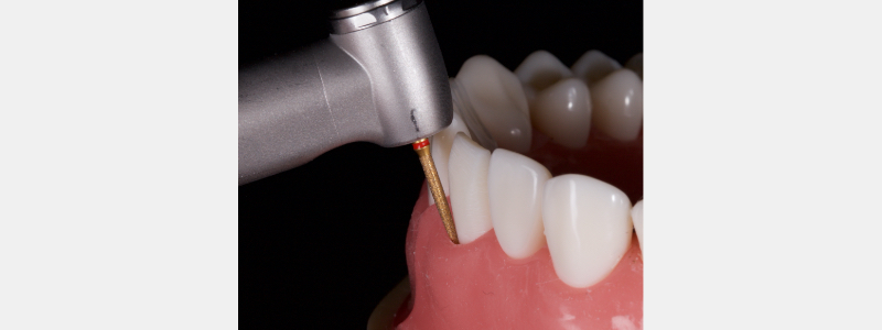 Old Tricks for New Dogs: Vertical Margin in Fixed Prosthodontics JasonSmithson OldTricksNewDogsVertMargin Fig.24