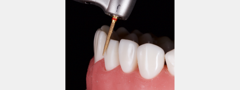 Old Tricks for New Dogs: Vertical Margin in Fixed Prosthodontics JasonSmithson OldTricksNewDogsVertMargin Fig.25