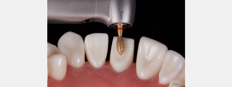 Old Tricks for New Dogs: Vertical Margin in Fixed Prosthodontics JasonSmithson OldTricksNewDogsVertMargin Fig.26