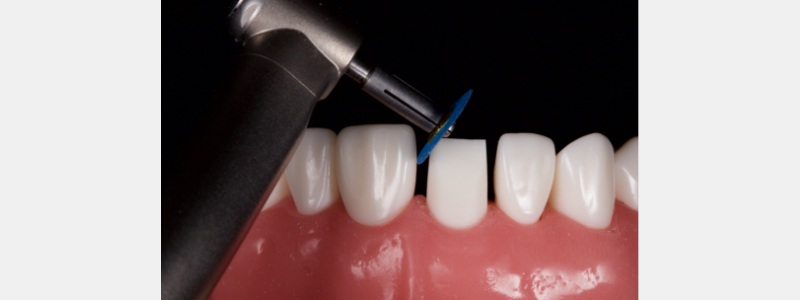 Old Tricks for New Dogs: Vertical Margin in Fixed Prosthodontics JasonSmithson OldTricksNewDogsVertMargin Fig.27